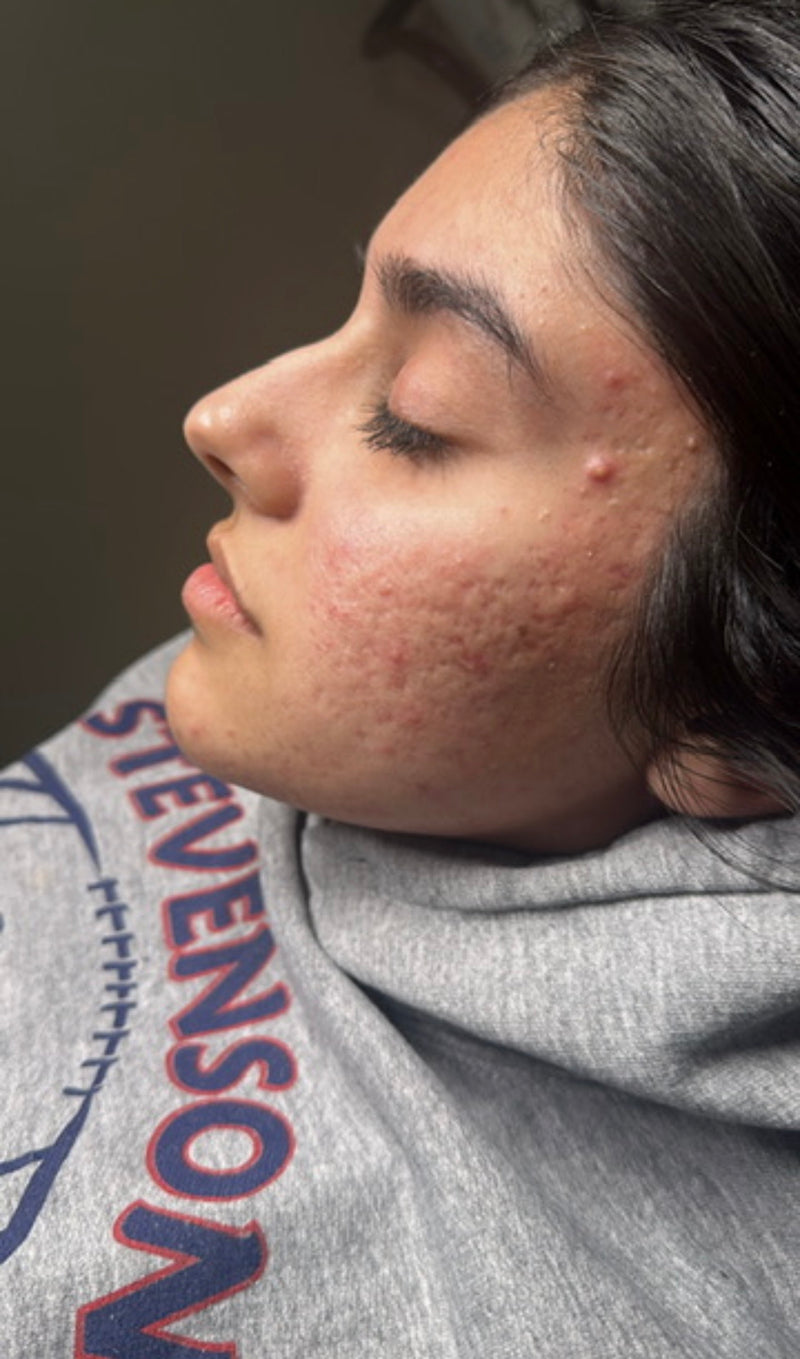 Before treatment
