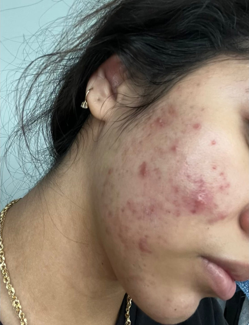 Before treatment