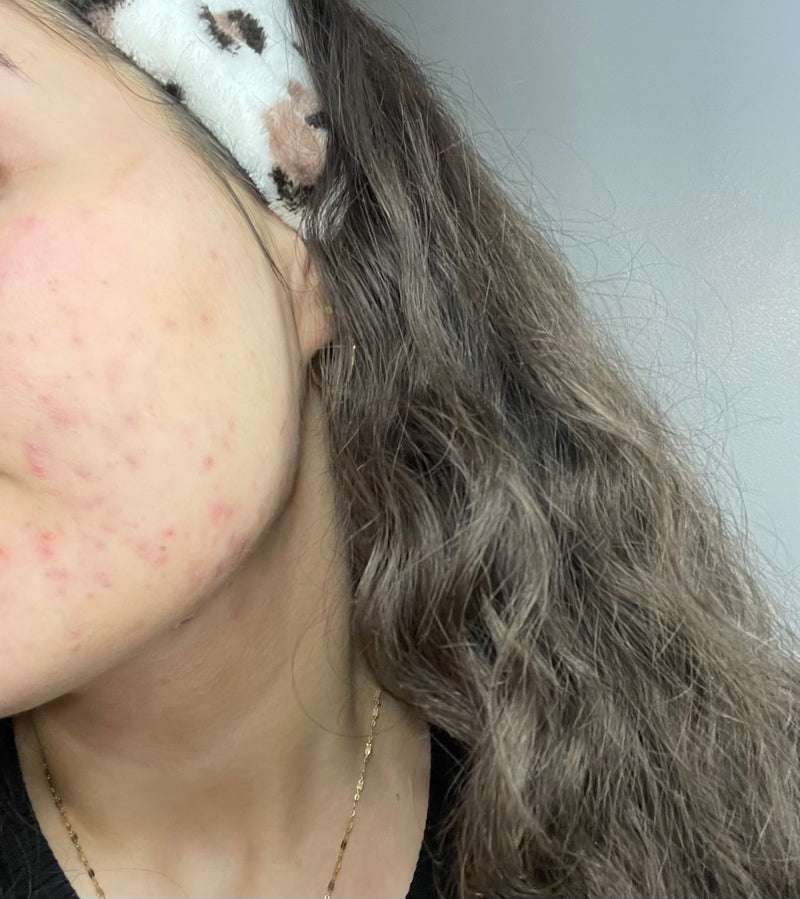 After treatment