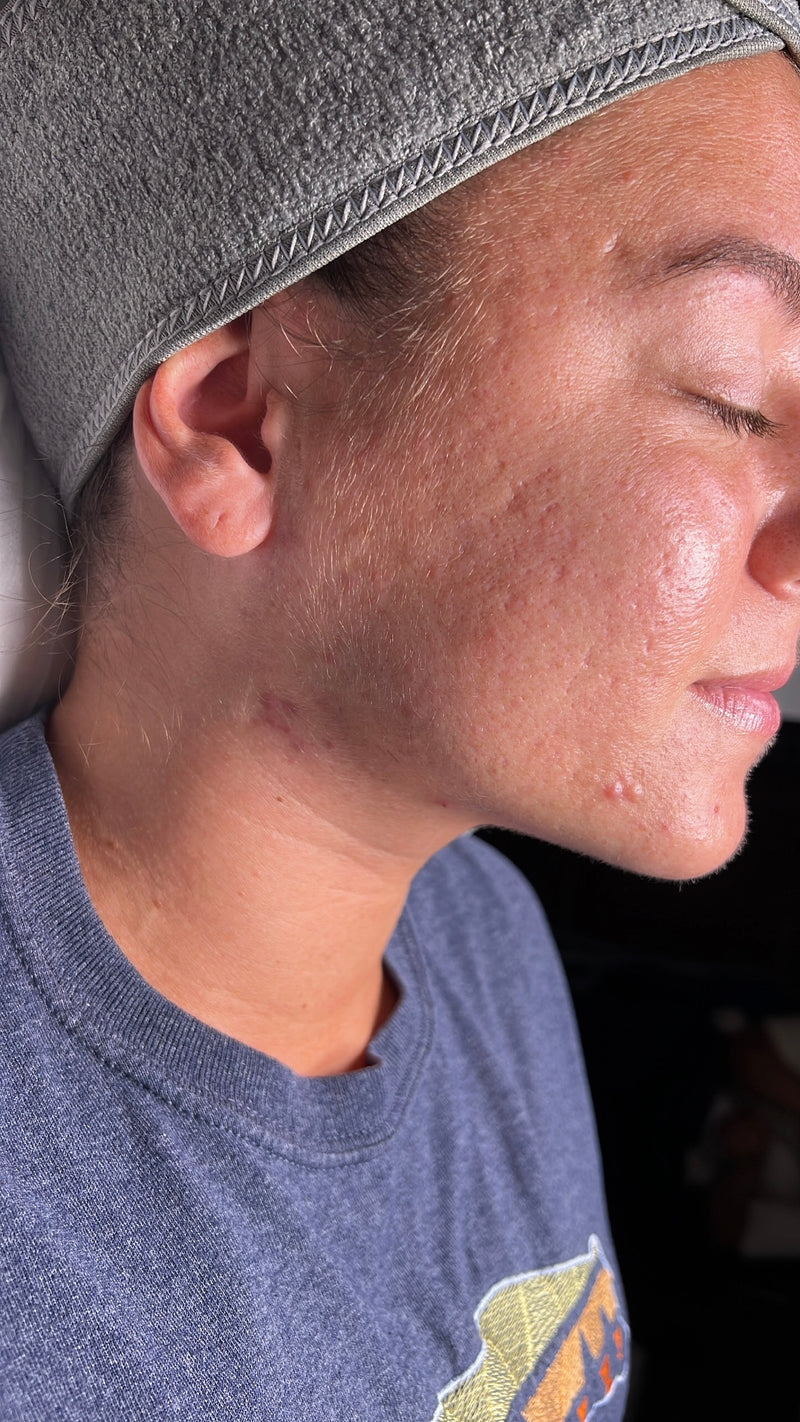 Before treatment