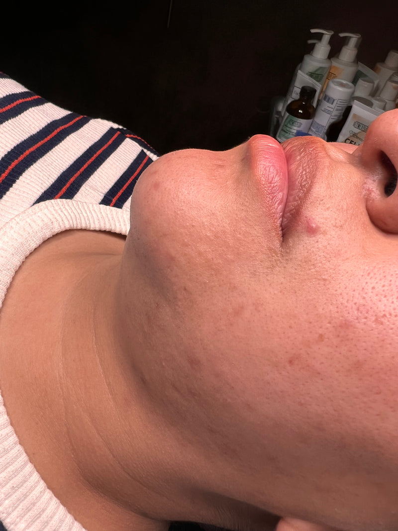Before treatment